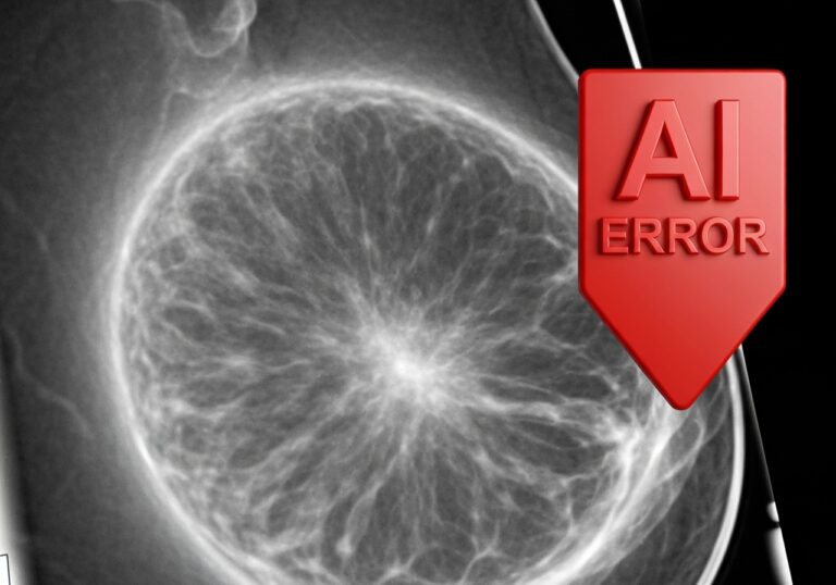 AI Mammography False Negatives: Dense Breasts & Missed Cancers Revealed